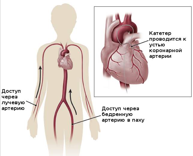Коронарография сердца