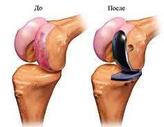 частичная замена коленного сустава