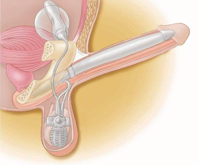 протез полового члена в пещеристых телах