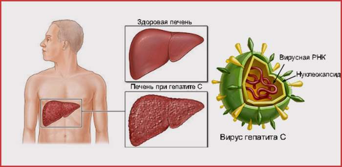 Гепатит С, печень, заболевание,