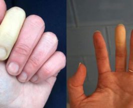 Синдром Рейно, феномен Рейно, пальцы,