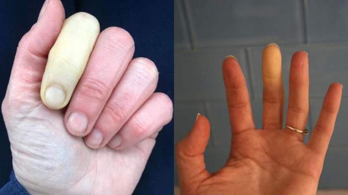 Синдром Рейно, феномен Рейно, пальцы,