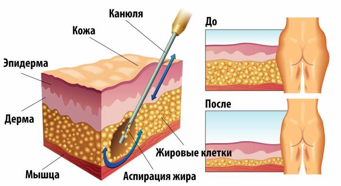 лазерная липосакция