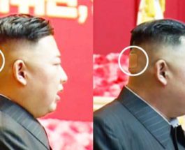 Ким Чен Ын, Северная Корея, затылок, пятно, травма,