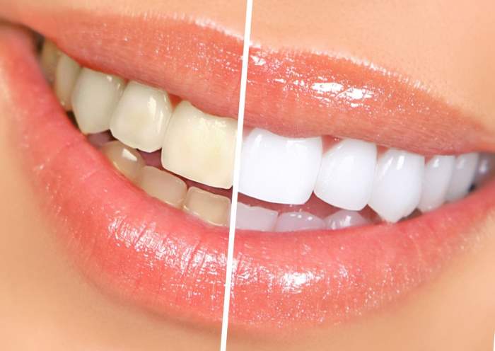 Способы отбеливания зубов - Круглосуточная стоматология Mr. Dent